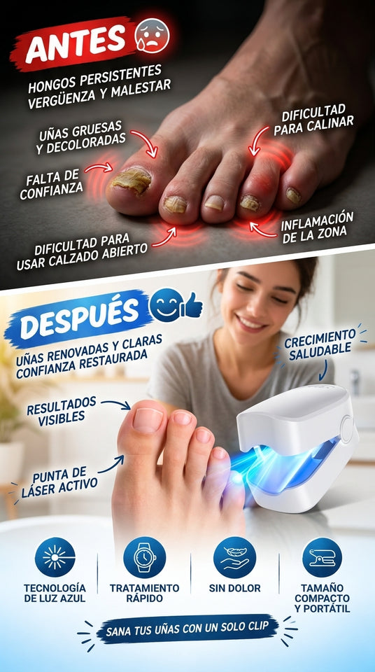 Nuevo Láser Antihongos para Uñas Saludable