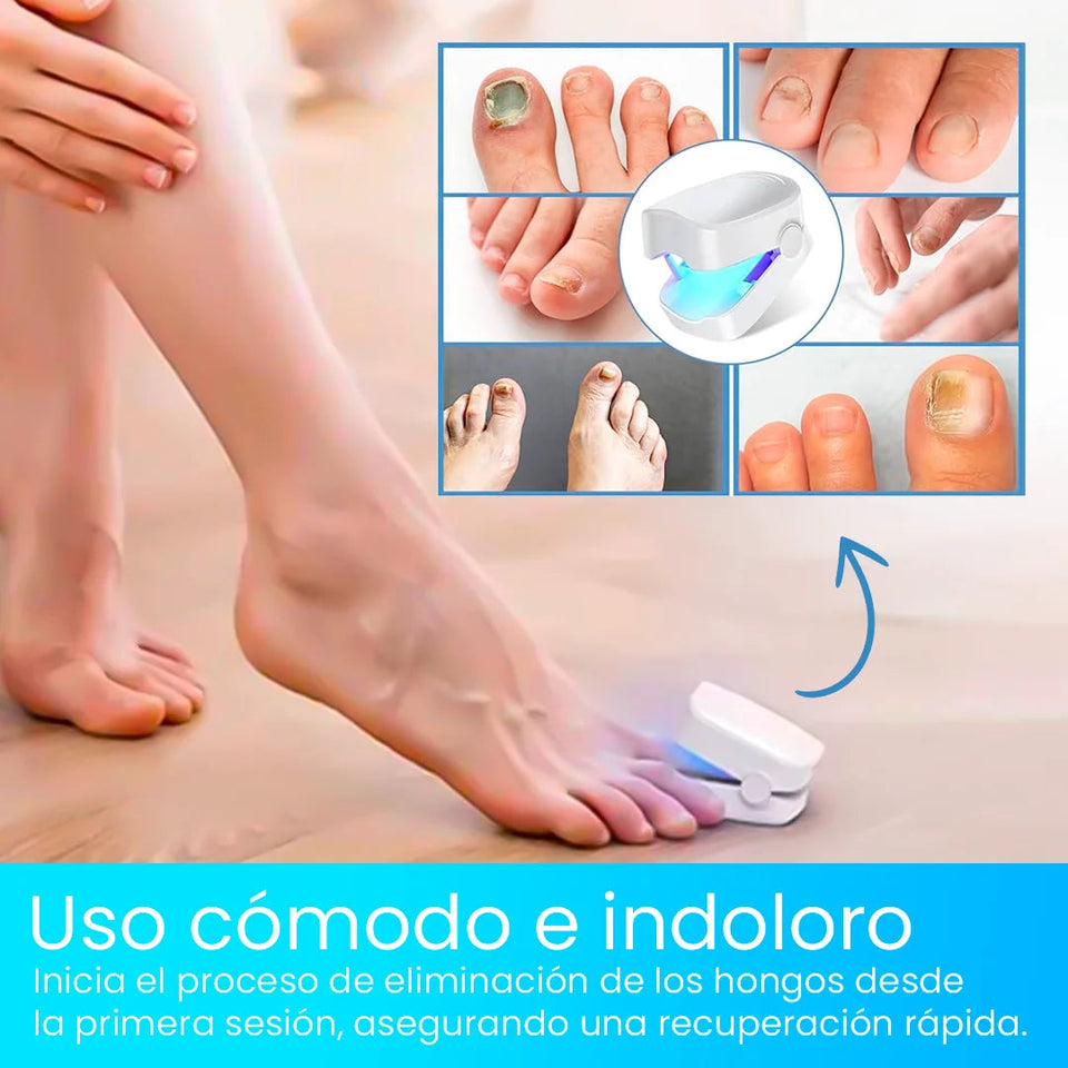 Nueva CuraLáser: Uñas Fuertes y Saludables