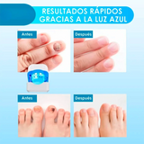 Nueva CuraLáser: Uñas Fuertes y Saludables