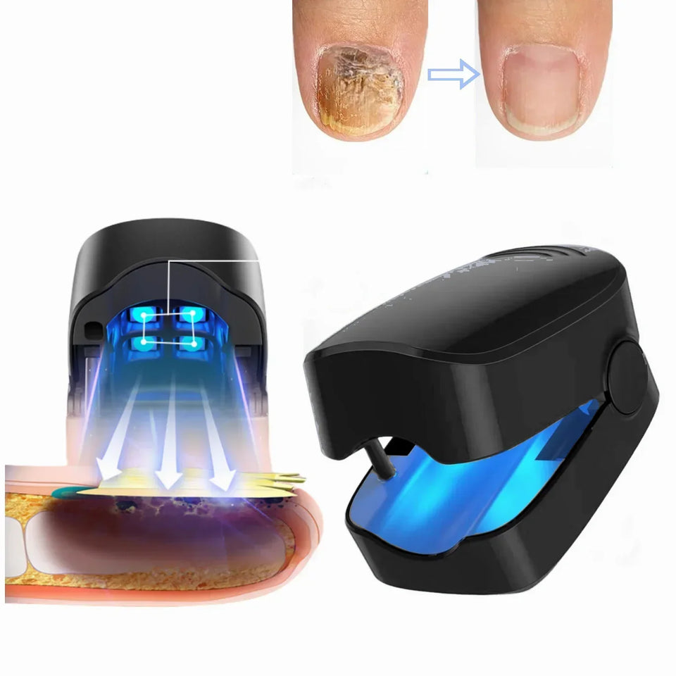 Nuevo Láser Antihongos para Uñas Saludable